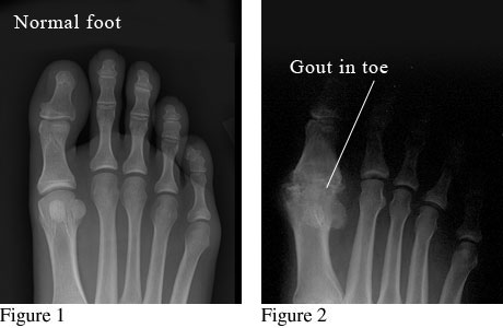 X-ray of Gouty Toe