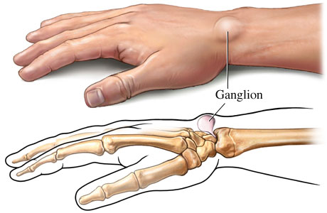 Cyst cure for ganglion How to