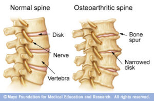 Osteoarthritis in the Spine