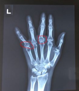 finger fracture